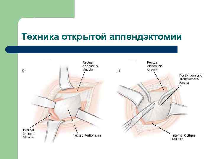 Техника открытой аппендэктомии 