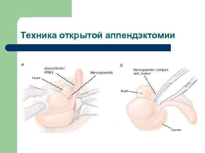 Техника открытой аппендэктомии 