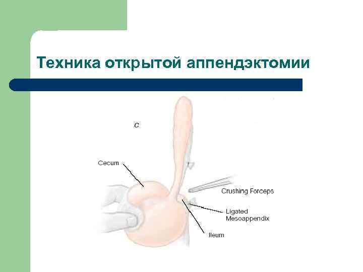 Техника открытой аппендэктомии 