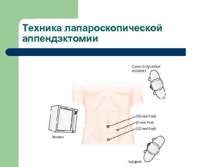 Техника лапароскопической аппендэктомии 