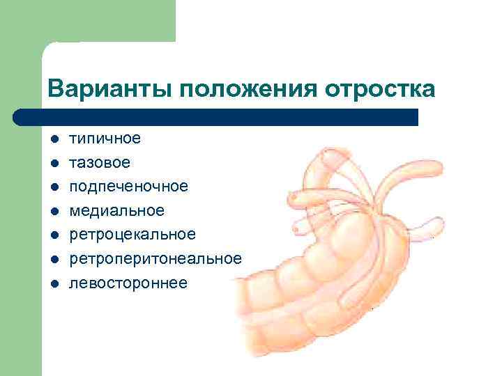 Варианты положения отростка l l l l типичное тазовое подпеченочное медиальное ретроцекальное ретроперитонеальное левостороннее