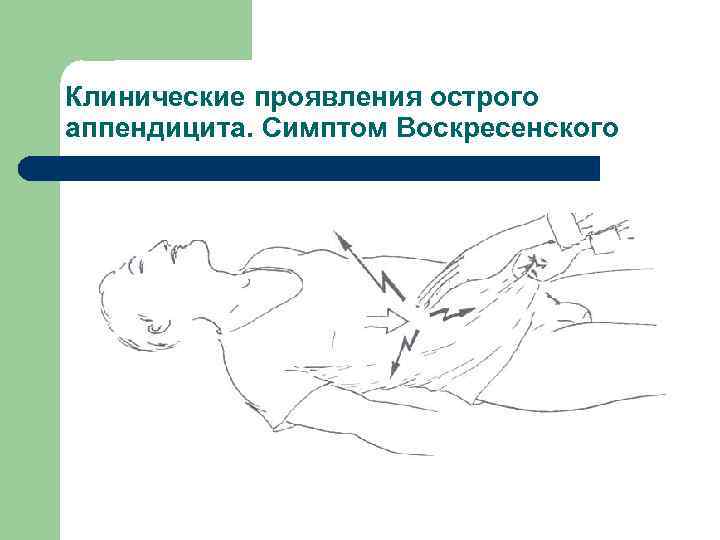 Разнообразие клинической картины при остром аппендиците связано с