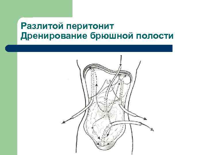 Разлитой перитонит Дренирование брюшной полости 