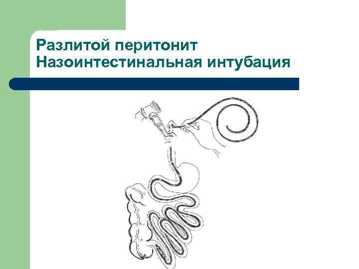 Разлитой перитонит Назоинтестинальная интубация 