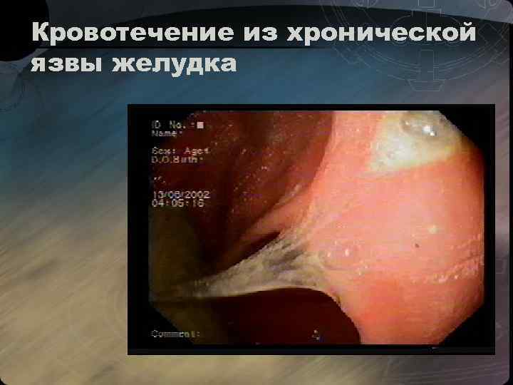 Кровотечение из хронической язвы желудка 