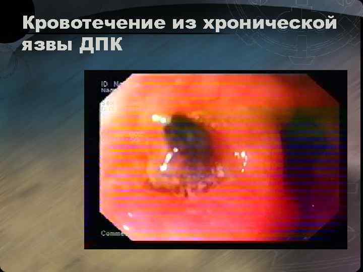 Кровотечение из хронической язвы ДПК 