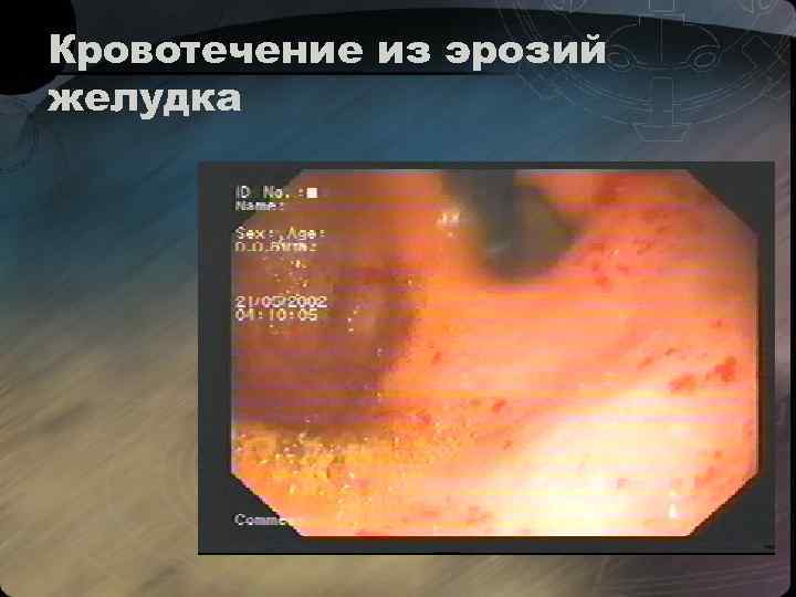 Кровотечение из эрозий желудка 