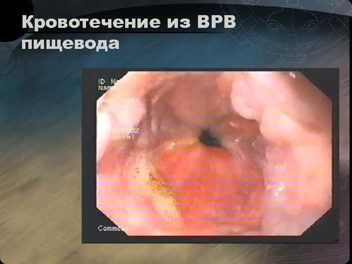 Кровотечение из ВРВ пищевода 