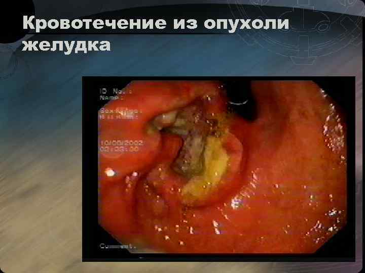 Кровотечение из опухоли желудка 