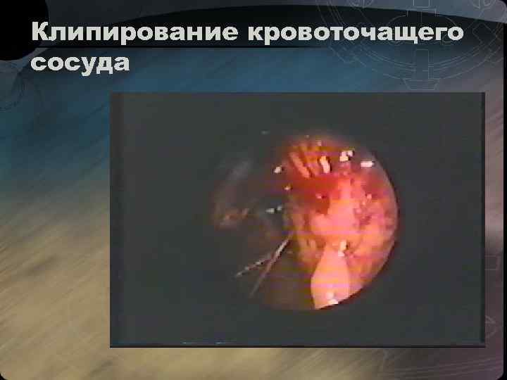 Клипирование кровоточащего сосуда 