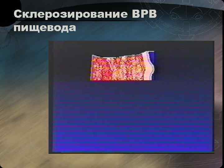 Склерозирование ВРВ пищевода 