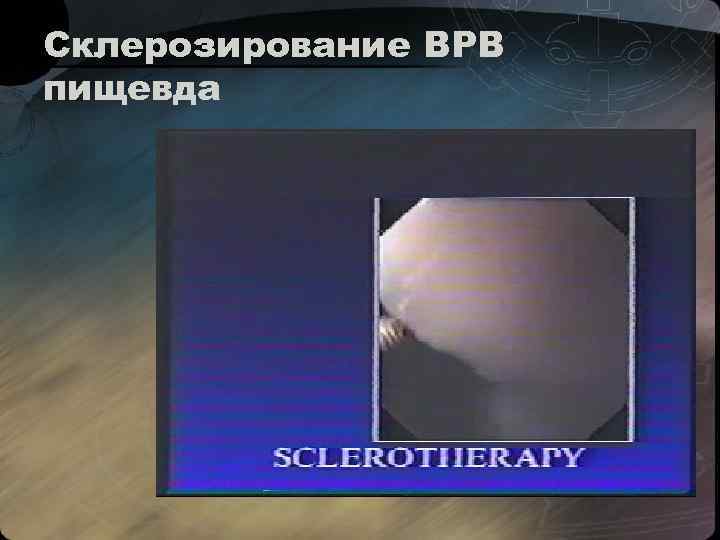 Склерозирование ВРВ пищевда 