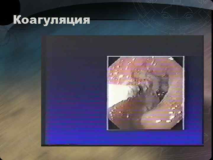 Коагуляция 