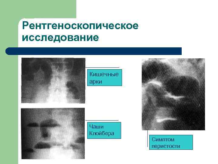 Рентгеноскопическое исследование Кишечные арки Чаши Клойбера Симптом перистости 