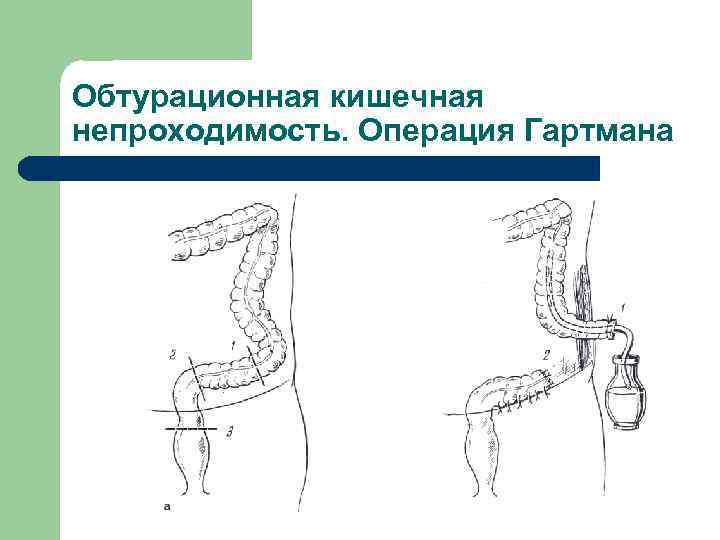 Обтурационная кишечная непроходимость. Операция Гартмана 