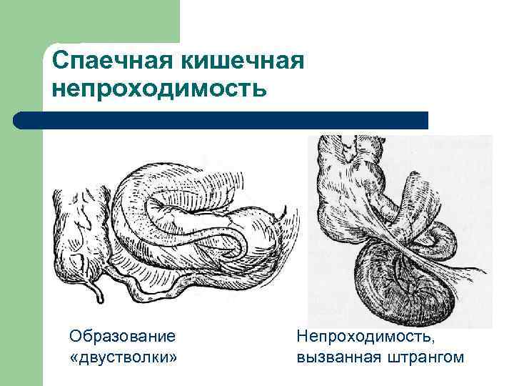 Кишечная непроходимость карта вызова