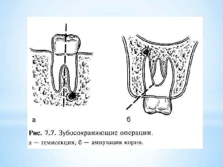 Что такое резекция зуба