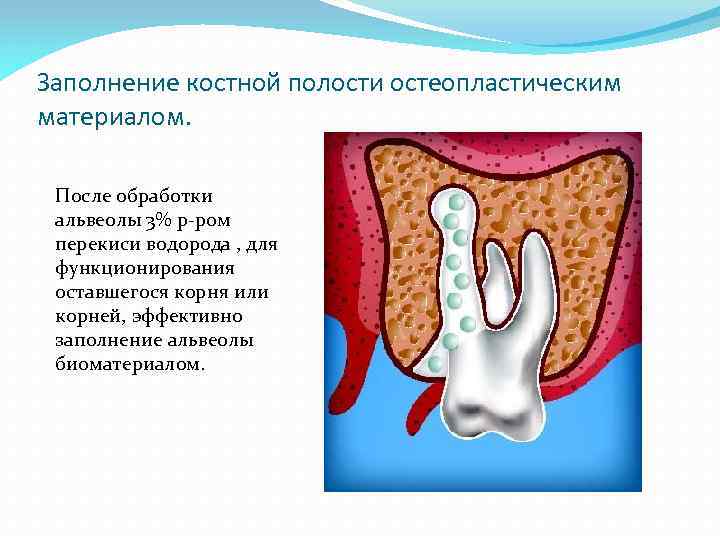 Костной полости