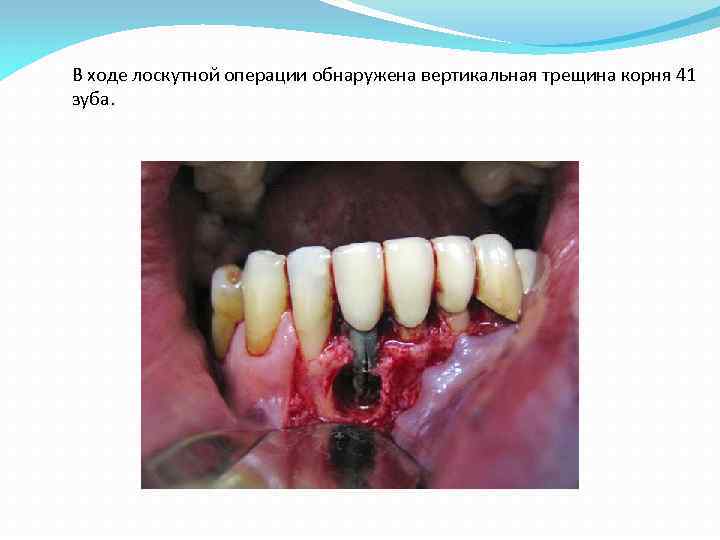 Перфорация корня зуба фото