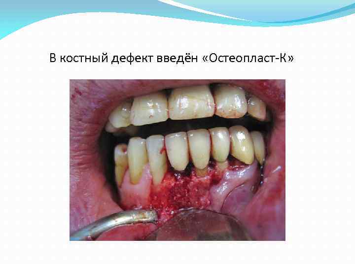 В костный дефект введён «Остеопласт-К» 