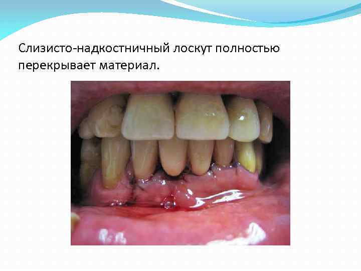 Слизисто-надкостничный лоскут полностью перекрывает материал. 