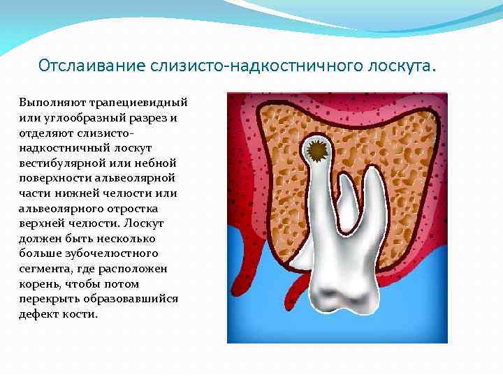 Отслаивание слизисто-надкостничного лоскута. Выполняют трапециевидный или углообразный разрез и отделяют слизисто надкостничный лоскут вестибулярной