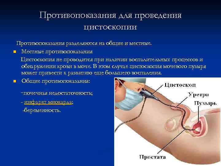 Противопоказания для проведения цистоскопии Противопоказания разделяются на общие и местные. n Местные противопоказания Цистоскопия