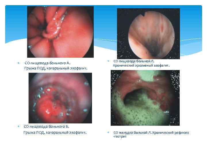  СО пищевода больного А. Грыжа ПОД, катаральный эзофагит. СО пищевода больного Б. Грыжа