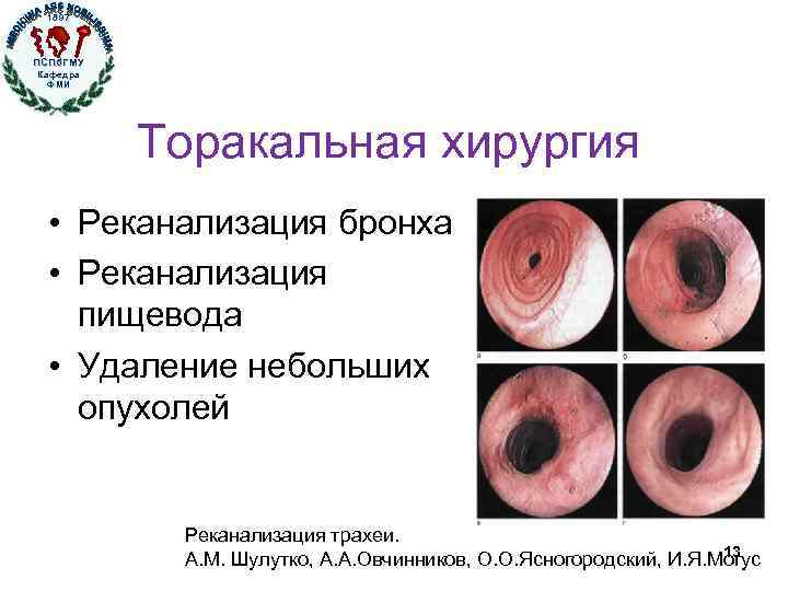 1897 ПСПб. ГМУ Кафедра ФМИ Торакальная хирургия • Реканализация бронха • Реканализация пищевода •