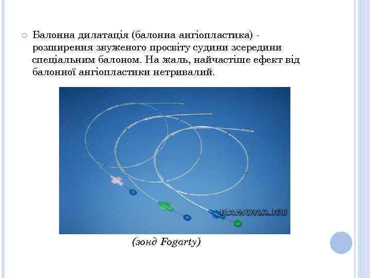  Балонна дилатація (балонна ангіопластика) розширення звуженого просвіту судини зсередини спеціальним балоном. На жаль,