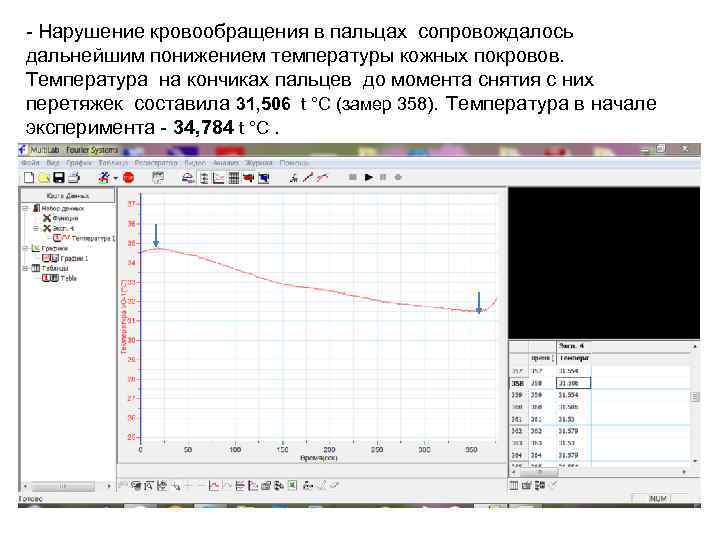 - Нарушение кровообращения в пальцах сопровождалось дальнейшим понижением температуры кожных покровов. Температура на кончиках