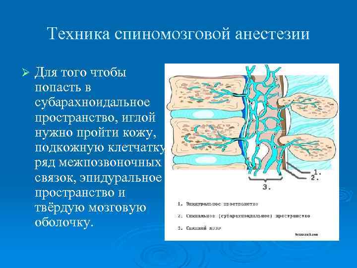 Техника спиномозговой анестезии Ø Для того чтобы попасть в субарахноидальное пространство, иглой нужно пройти