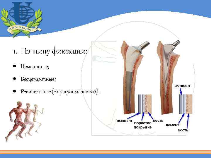 1. По типу фиксации: Цементные; Бесцементные; Ревизионные (с артропластикой). 