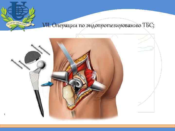 VII. Операции по эндопротезированию ТБС; 