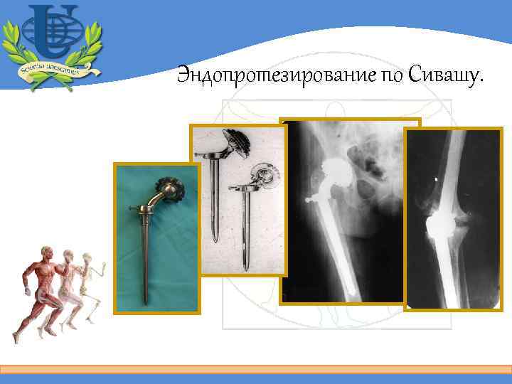 Эндопротезирование по Сивашу. 