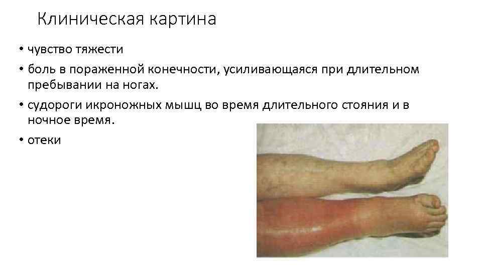 Клиническая картина • чувство тяжести • боль в пораженной конечности, усиливающаяся при длительном пребывании