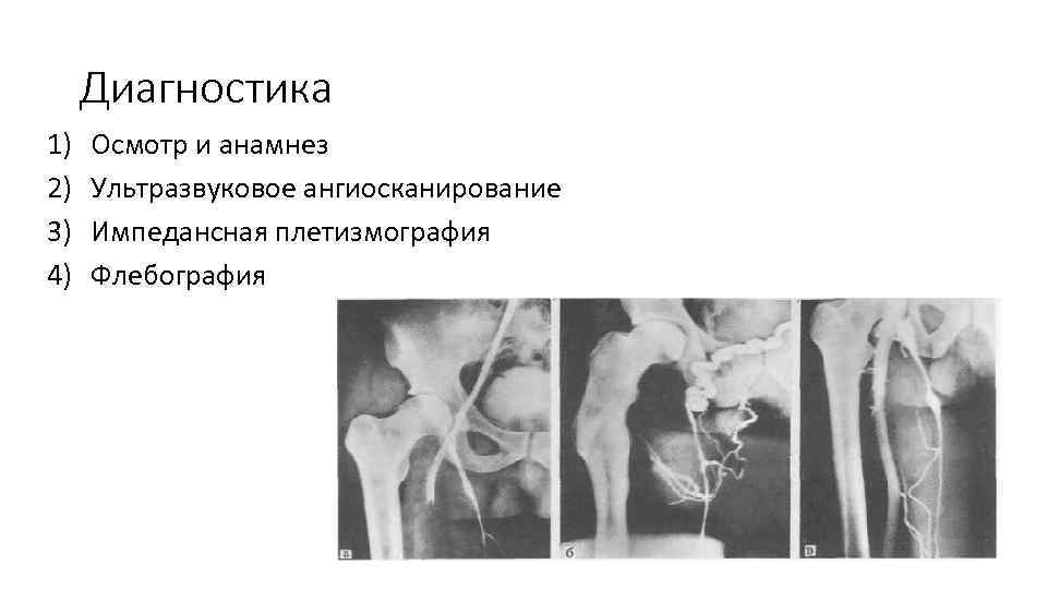 Диагностика 1) 2) 3) 4) Осмотр и анамнез Ультразвуковое ангиосканирование Импедансная плетизмография Флебография 