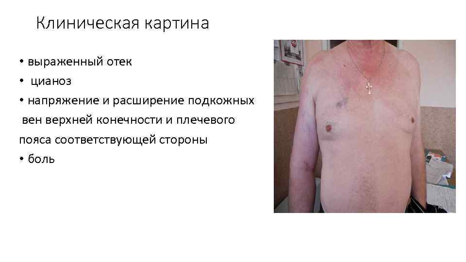 Клиническая картина • выраженный отек • цианоз • напряжение и расширение подкожных вен верхней