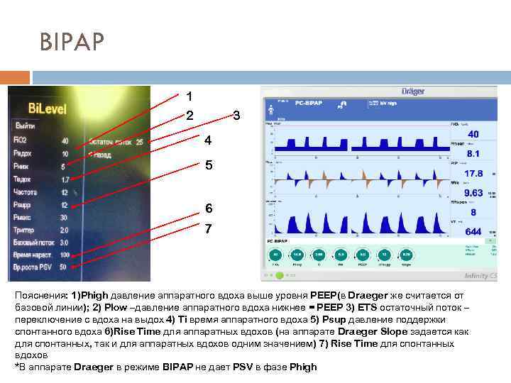 BIPAP 1 2 3 4 5 6 7 Пояснения: 1)Phigh давление аппаратного вдоха выше