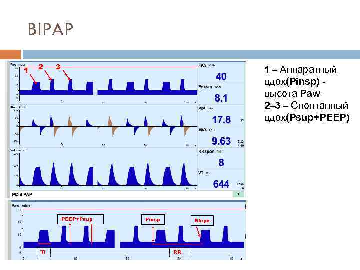 BIPAP 1 2 3 1 – Аппаратный вдох(Pinsp) высота Paw 2– 3 – Спонтанный