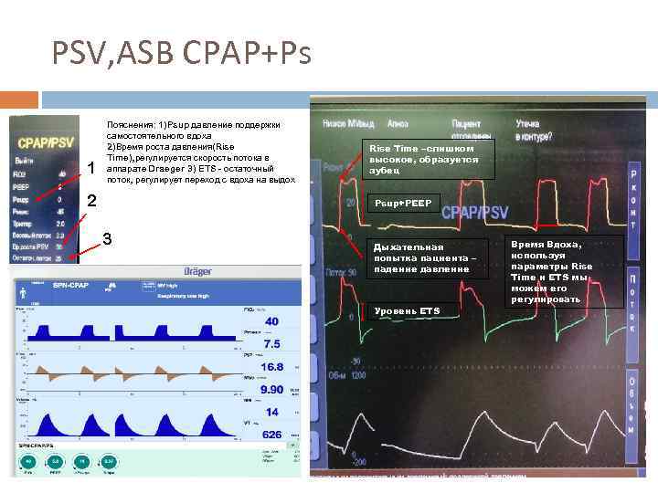 PSV, ASB CPAP+Ps 1 Пояснения: 1)Psup давление поддержки самостоятельного вдоха 2)Время роста давления(Rise Time),
