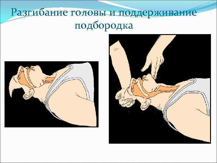 Разгибание головы и поддерживание подбородка 