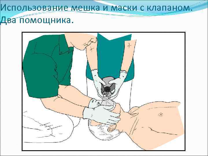 Использование мешка и маски с клапаном. Два помощника. 
