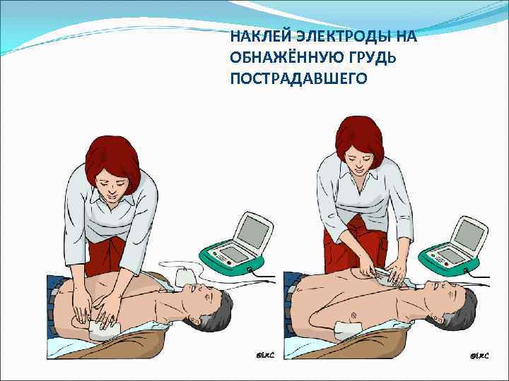 НАКЛЕЙ ЭЛЕКТРОДЫ НА ОБНАЖЁННУЮ ГРУДЬ ПОСТРАДАВШЕГО 