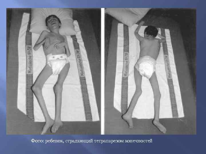 Фото: ребенок, страдающий тетрапарезом конечностей 