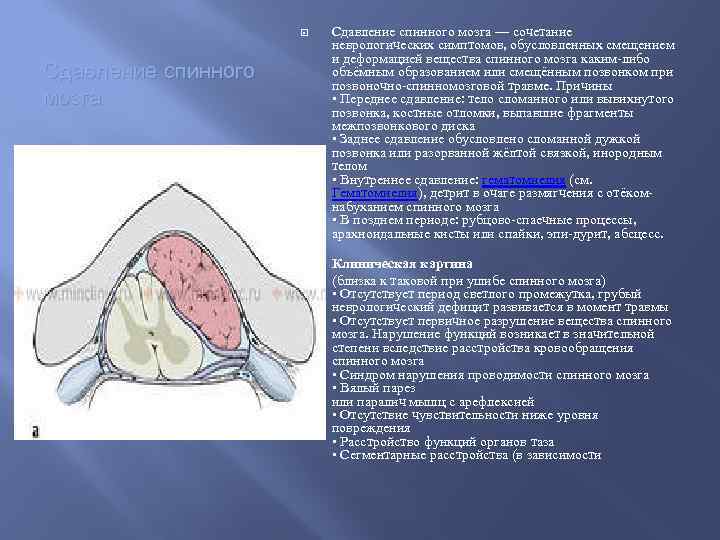  Сдавление спинного мозга — сочетание неврологических симптомов, обусловленных смещением и деформацией вещества спинного