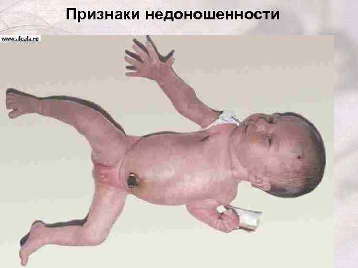 Признаки недоношенности 