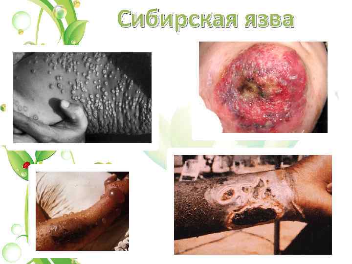 Сибирская язва 