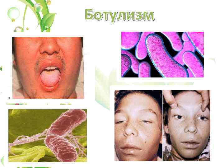 Ботулизм 