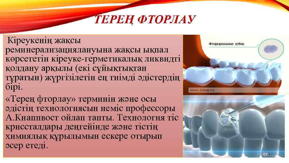 ТЕРЕҢ ФТОРЛАУ Кіреукенің жақсы реминерализациялануына жақсы ықпал көрсететін кіреуке-герметикалық ликвидті қолдану арқылы (екі сұйықтықтан